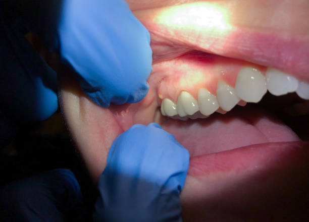 Best Emergency Wisdom Teeth Removal in Mullens, WV
